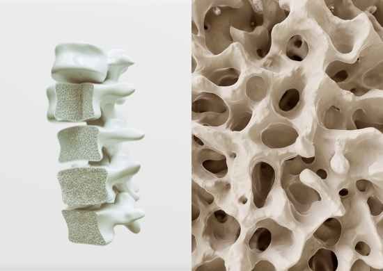 Treatement of osteoporosis